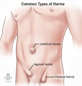 hernia
