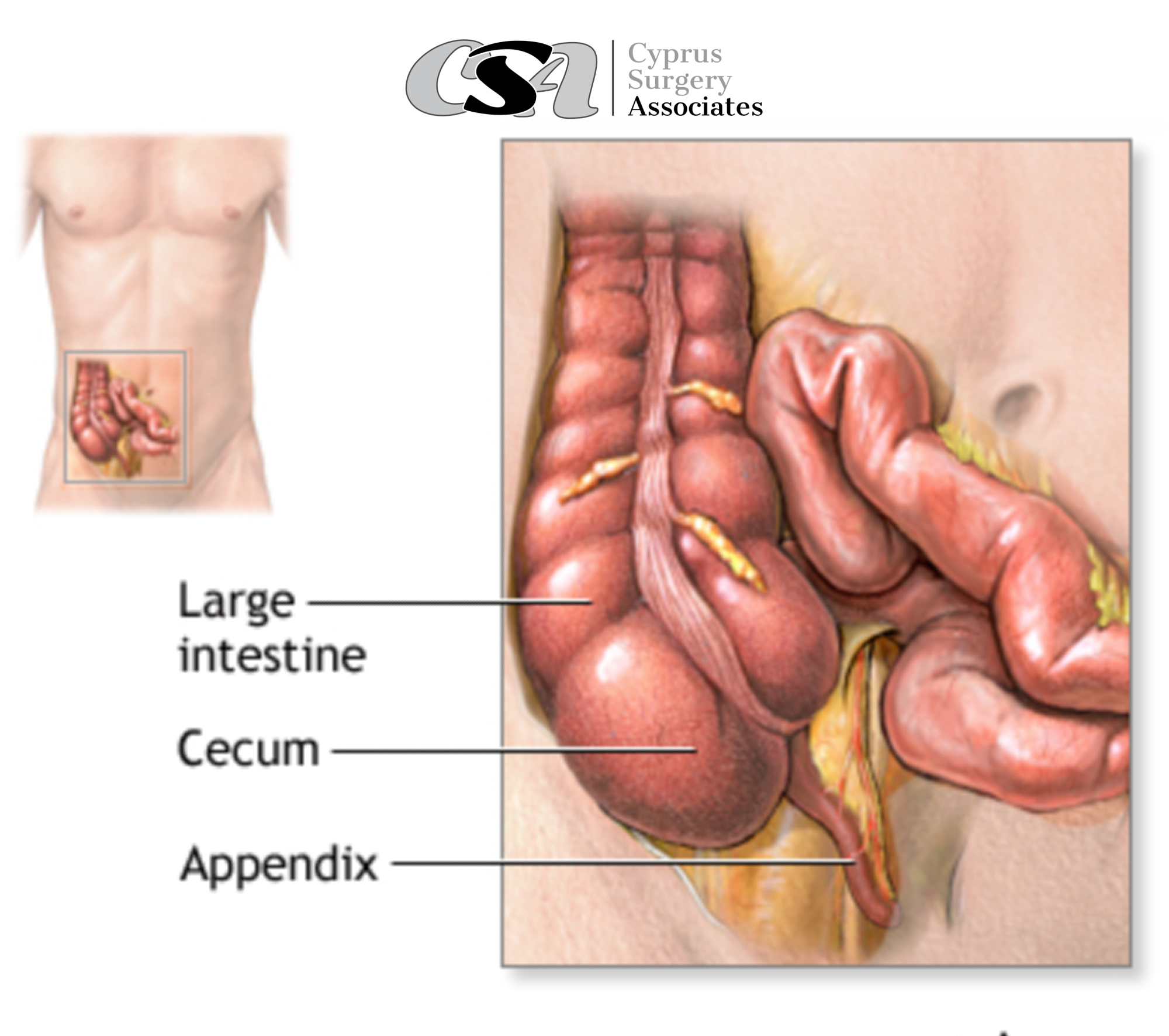 Acute Appendicitis | Medical emergency | Nikos Vlachos