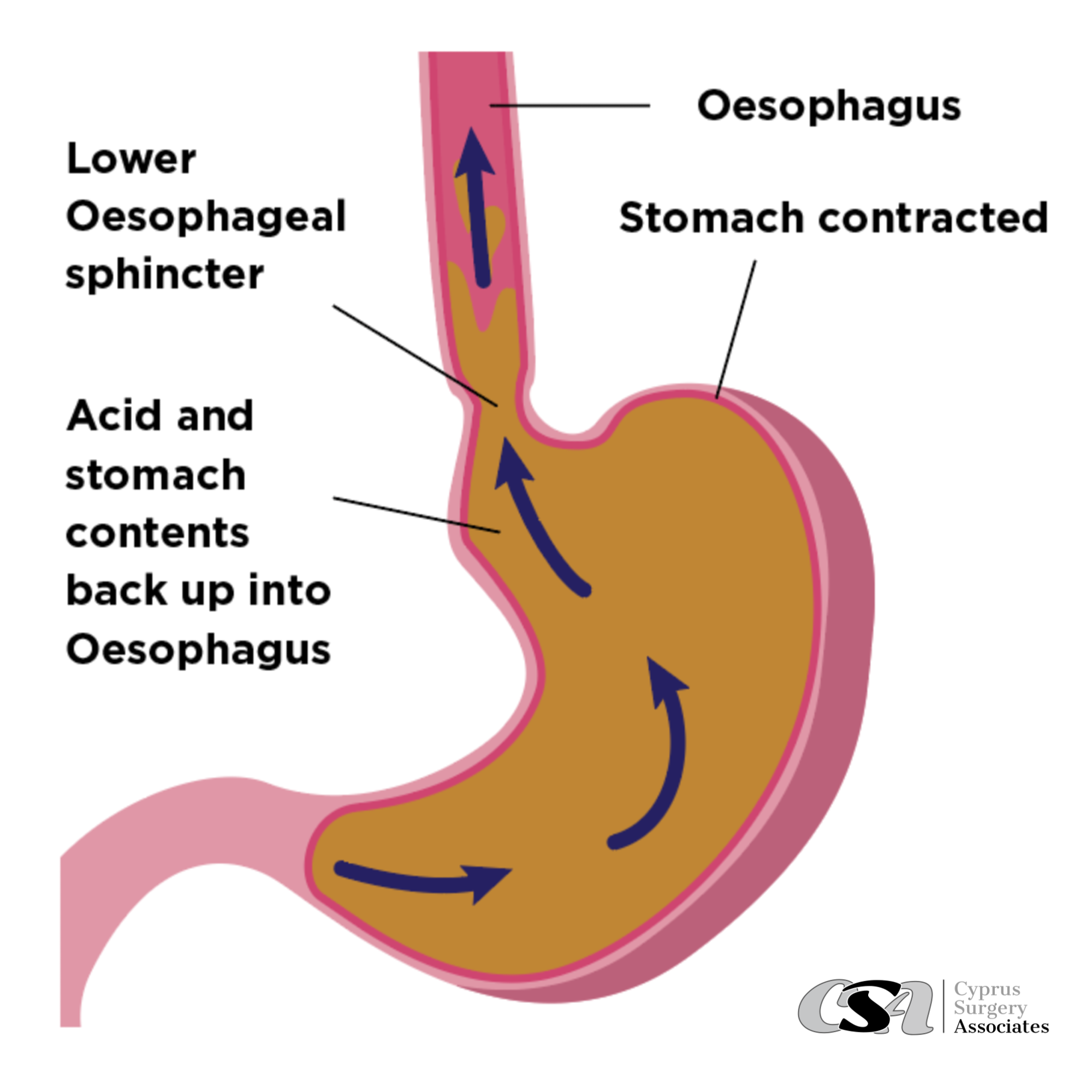bpc 157 barrett's esophagus Barrett's Esophagus: Symptoms, Causes, Types & Complications