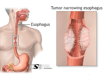 Barrett's esophagus -   |