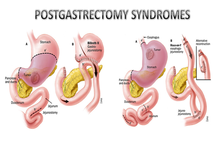 Dumping Syndrome